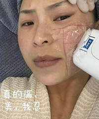 34岁超声炮抗衰体验,我的眼尾都扬起来了,下颚线清晰可见!