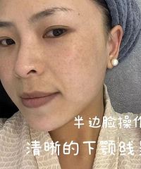 34岁超声炮抗衰体验,我的眼尾都扬起来了