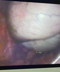 16��Ů������ʹ��ҽ��һ�龪�ˣ�15cm�޴��ѳ����ף�