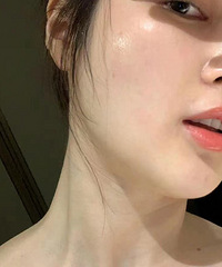 一月一次的光子嫩肤给了我好皮肤,白嫩细腻了很多