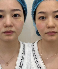 本来觉得泪沟显老,结果听了医生的建议,苹果肌饱满了就年轻了