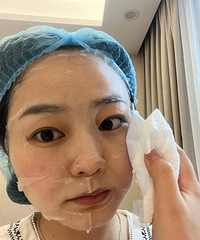 本来觉得泪沟显老,做了这个后,变化好明显