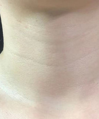 颈纹深的姐妹听我一句,嗨体早打早开心!第一次淡化效果就很满意