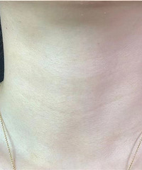 颈纹淡化后好显年轻