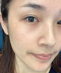 超皮秒祛斑效果到底怎么样?我来原相机直出恢复过程告诉你
