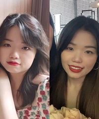 瘦脸针一个月效果真的超级惊喜!我的方脸变成小V脸了