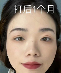 瘦脸针一个月效果真的超级惊喜!方脸变成小V脸了
