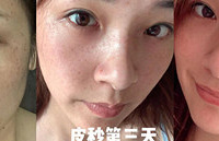 超皮秒祛斑效果怎么样?原相机直出恢复过程告诉你