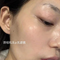 水光针一年的皮肤状态