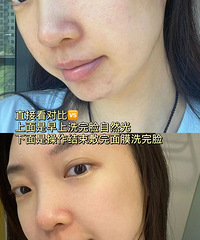 做完超光子的第5天,赶快来记录一下我的感受!皮肤肉眼可见亮了