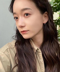 颧骨外扩凹陷好显老!填充之后,感觉年轻了10岁
