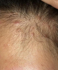脂皮+痤疮+头皮长痘的姐妹进,花钱询问了丁香医生得到如下反馈