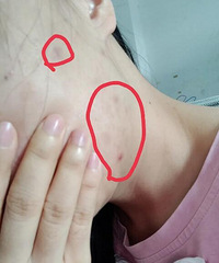给黑痘印的长痘姐妹们倾情安利这个精华,祛黑痘印的王者