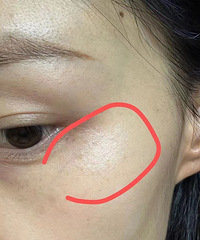 最近发现外眼角开始长斑了,好焦虑呀!咋办呢?