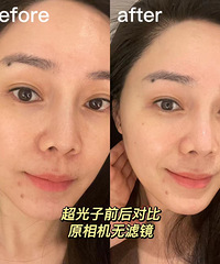 坚持做了5次黄金超光子,皮肤变化真的肉眼可见