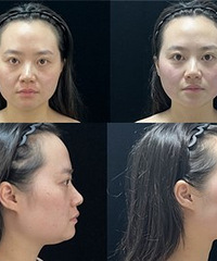 做一次超声炮有什么变化?看我就知道了