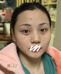 超皮秒祛斑,今年性价比最高的变美项目了