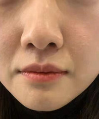 30岁的我也踏上抗衰之路,鼻基底法令纹填充真香,瞬间减龄好几