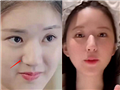 赵露思的鼻子整了?