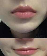 时隔1年,再来分享我做的医美项目,这次去do了唇