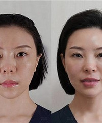 做了口周抗衰,一下子年轻5岁