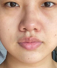 我觉得超光子绝对是最值得的医美!原相机直出,效果满意极了