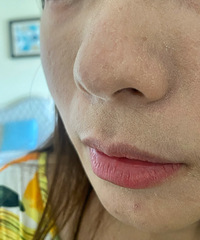 入秋了,做个微针给干燥的皮肤喝饱水吧