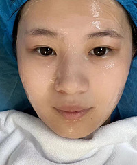 光子嫩肤3次, 没整容, 但像换了个人!