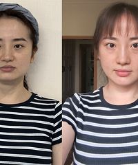 做完超声炮,我的脸小了一个尺寸!趁现在活动价便宜,我囤了2次
