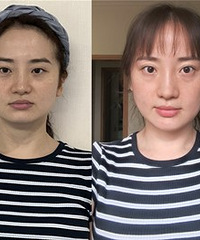 做完超声炮,我的脸小了一个尺寸