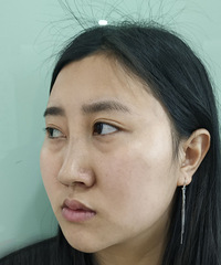 眼袋祛了泪沟没了,真香