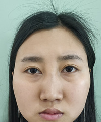 眼袋祛了泪沟没了,真香