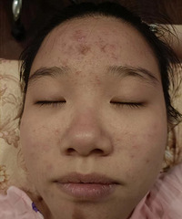 长了4年的痘痘,没想到用这个方法治好了