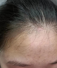 一篇妈妈日记,脸上的痘痘干净了,孩子也自信了很多