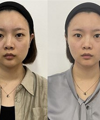 做完超声炮2周后,脸小了太多了吧