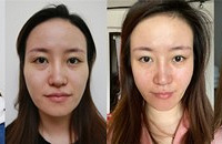 做了黄金超光子+水光,皮肤不泛红了,还细腻很多