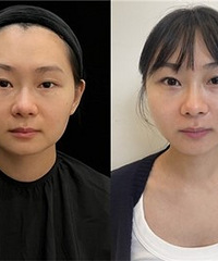 这个抗衰项目确实不错,脸变小一圈