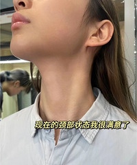 脖子终于干干净净了!没了颈纹,感觉都年轻了很多