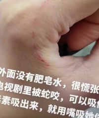 男生模仿电视剧用嘴帮女友吸伤口