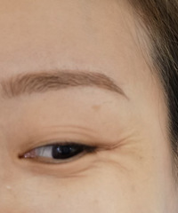 眼霜真的祛不掉鱼尾纹,除皱针才能一杆见影!大笑都没眼纹了
