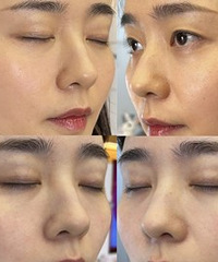 做一次黑金DPL超光子,肤色变化真大