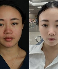 做完超声炮,我变成小尖脸了