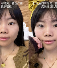 98元的正版DPL黑金超光子做了,全素颜的肤色提亮了好多呀