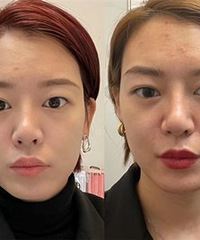 超声炮还真能淡化法令纹,让人显年轻