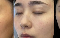黑金DPL超光子才98元一次,做完肤色亮3倍