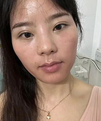 祛斑护肤产品真的没效果!做一次超皮秒,斑斑少了皮肤也光滑了