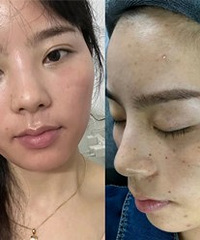 做一次超皮秒,斑斑少了皮肤也光滑了