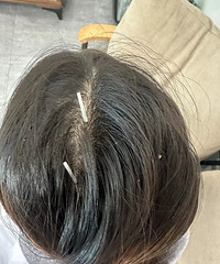 空心针针灸,居然缓解了我多年的头痛问题