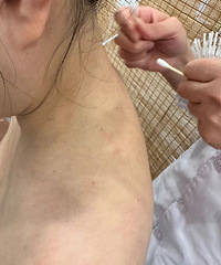 肩颈痛到都低头困难了,做5次针灸理疗,每次都感觉更好一点