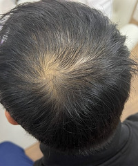 脱发问题严重,皮肤科专家刁庆春也能治!这里看病,挂号很轻松